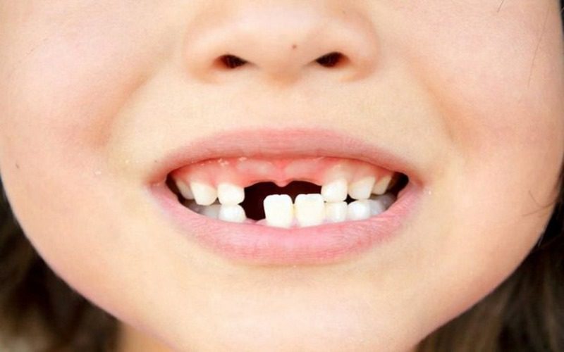 Rụng răng hàm trên trong giấc mơ cũng báo hiệu sức khỏe đang có vấn đề